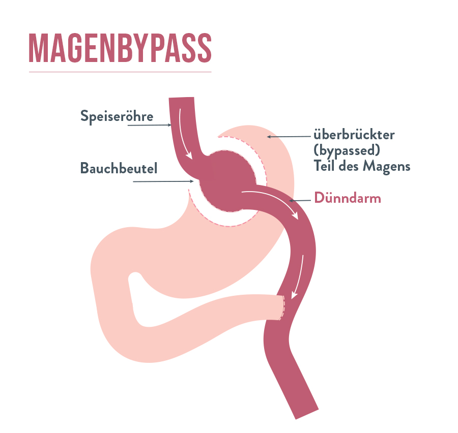 Magen-bypas - Gastric Bypass | Bariatric Advantage