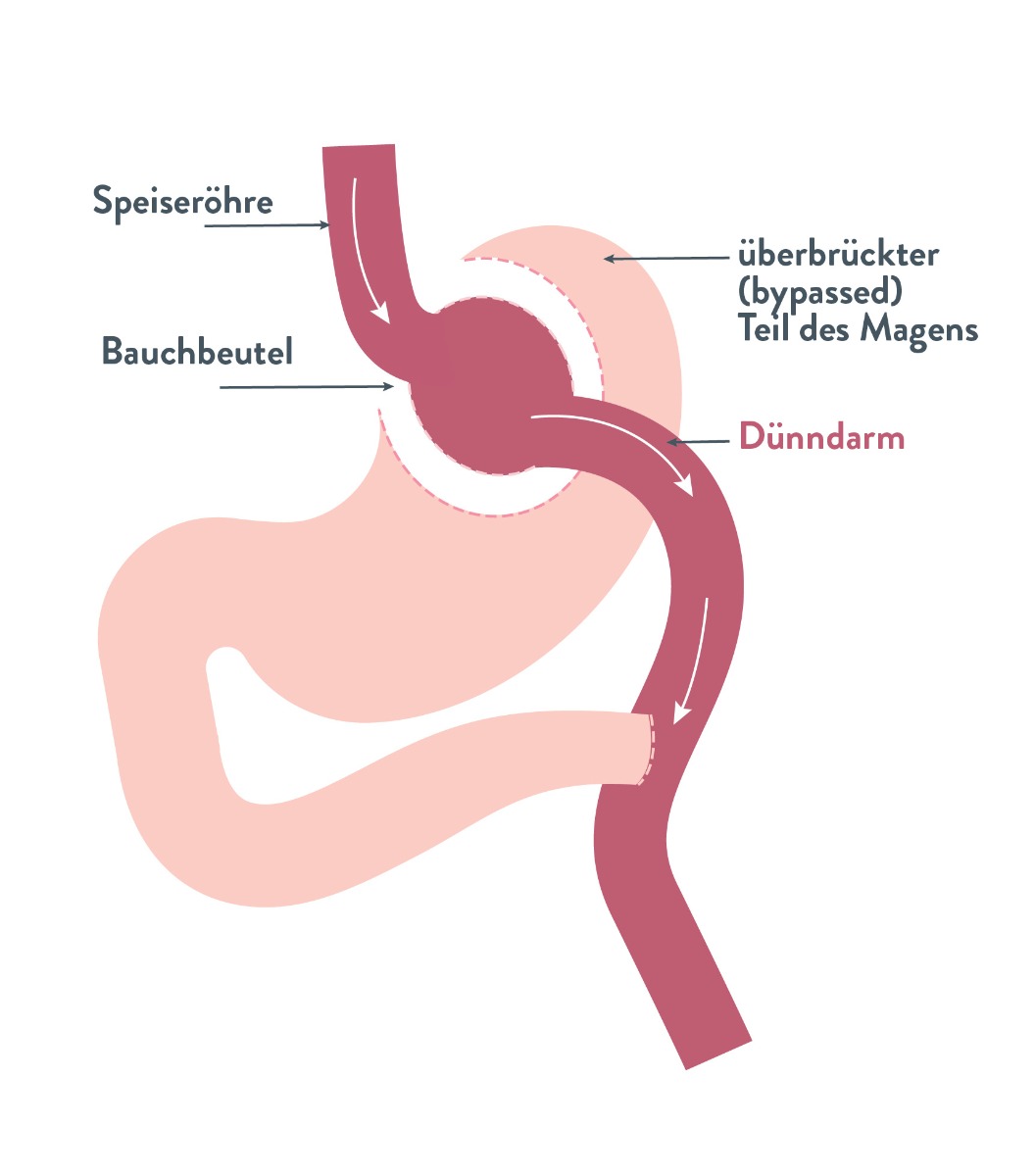 Bild Magenbypass - gastric Bypass | Bariatric Advantage