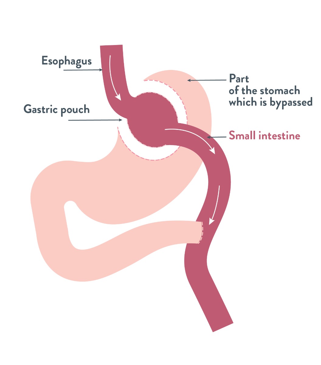 Gastric Bypass | Bariatric Advantage