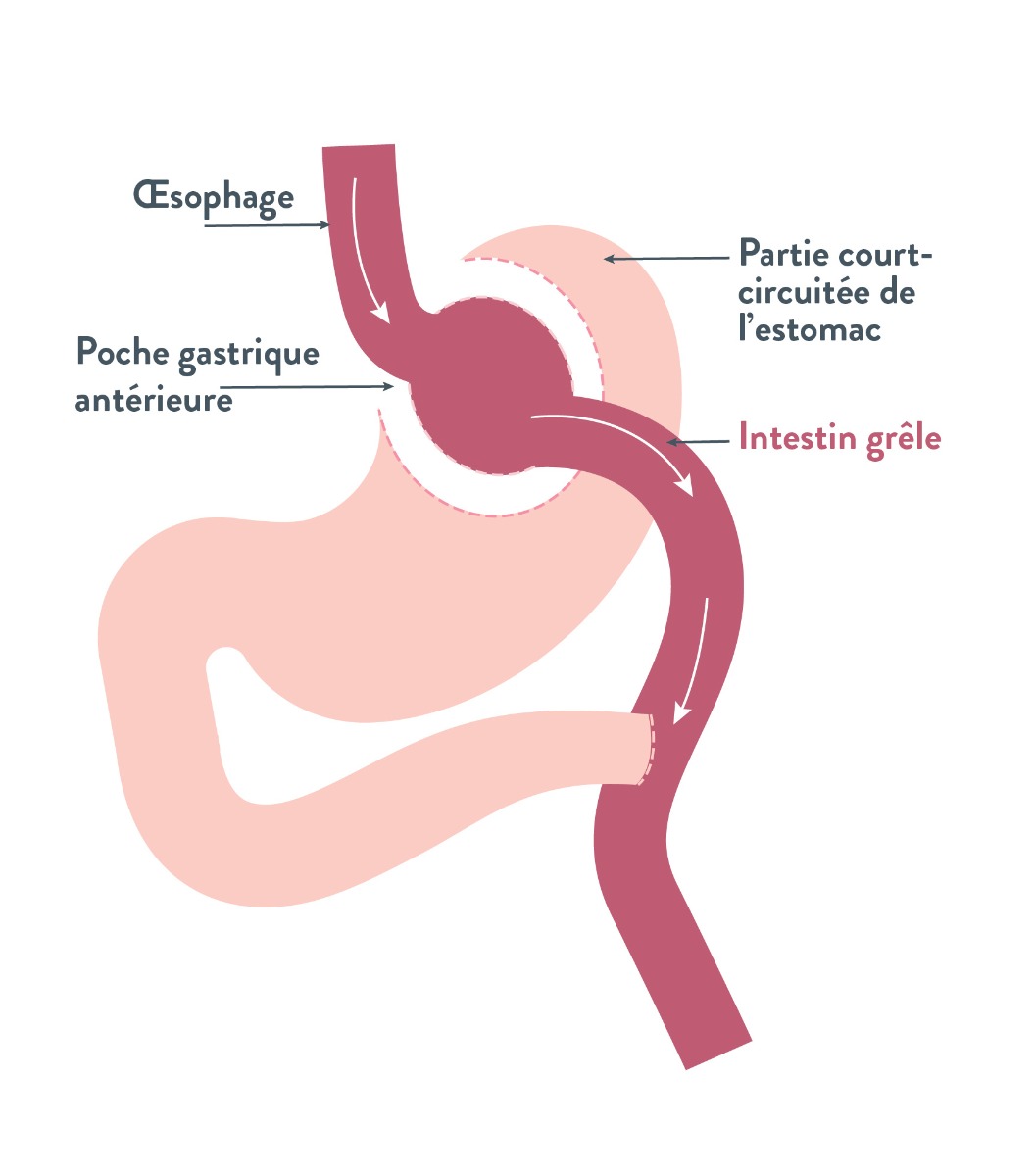 La dérivation gastrique (gastric bypass) | Bariatric Advantage
