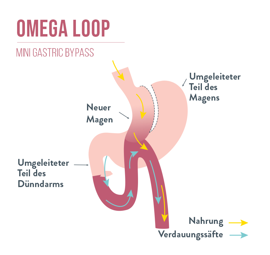 Omega Loop | Mini Gastric bypass
