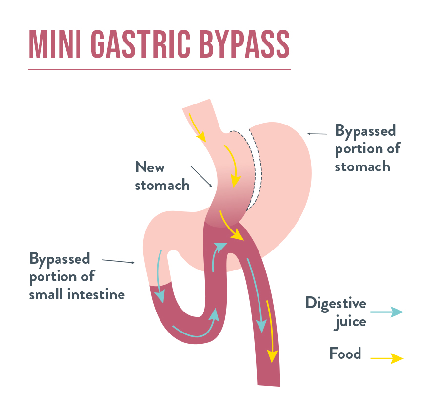 Mini Gastric Bypass