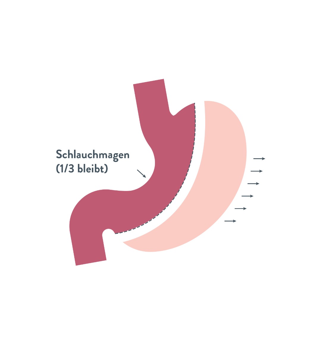 Bild Schlauchmagen - sleeve |Bariatric Advantage