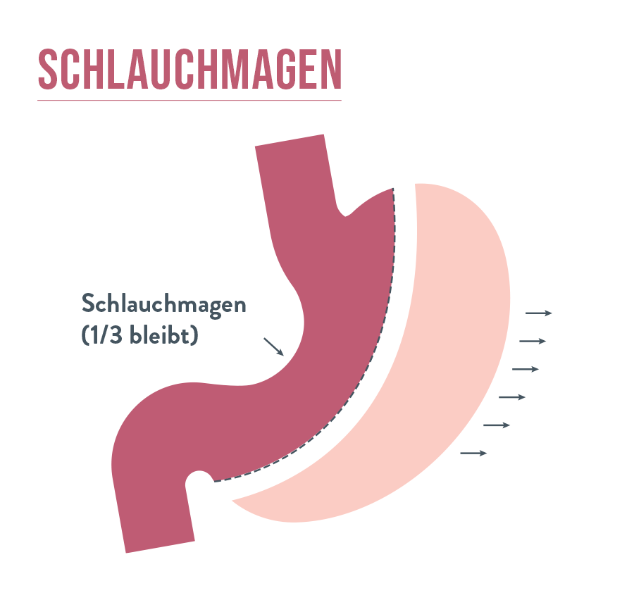 Schlauchmagen - Sleeve Gastrectomy | Bariatric Advantage