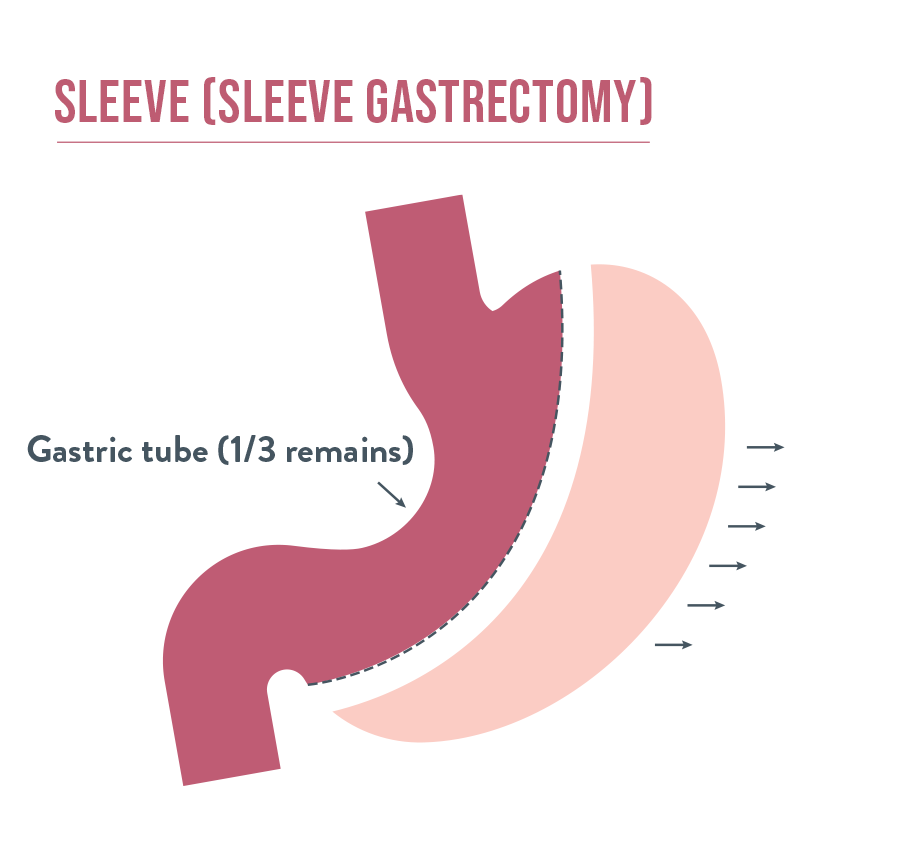 Sleeve Gastrectomy | Bariatric Advantage