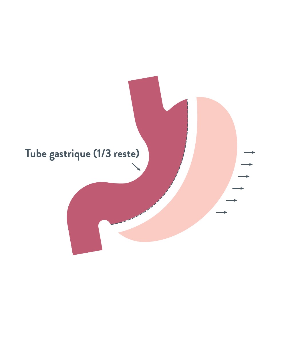 Image sleeve ou gastrectomie longitudinale | Bariatric Advantage